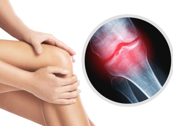 οστεοαρθριτιδα γονατος οστεοαρθριτιδα γονατος