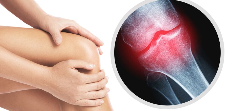 οστεοαρθριτιδα γονατος οστεοαρθριτιδα γονατος