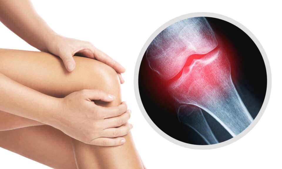 οστεοαρθριτιδα γονατος